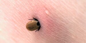 How to Remove a Tick?